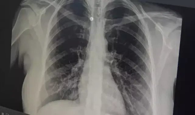 Akut Bronşit Belirtileri ve Tedavi Yöntemleri